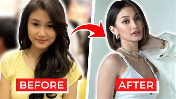 Charlie Dizon Before Surgery | Filipino Actress Plastic Surgery Transformation